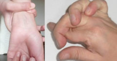 Hajlékony ennyire a kezed? Valószínűleg Marfan szindrómában szenvedsz.