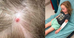 Egy 5 éves gyereknek hirtelen beszéd- és járási nehézségei támadtak. Ekkor az anyja észrevett egy vörös foltot a fején