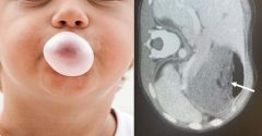 Egy 5 éves kisfiú 40 rágógumit evett meg egyszerre. Ez játszódott le a gyomrában