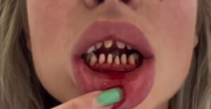 Törökországban új fogakat csináltatott, de most az emberek kinevetik. Mi van a szájában?