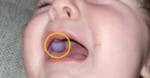 Az orvosok azt hitték, hogy a csecsemőnek daganata van a szájában. Kiderült, hogy minden teljesen másképp van