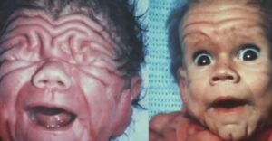 Szokatlan életkezdet: A gyermekből, aki felesleges bőrrel született, ma már egy harmincas éveiben járó férfi